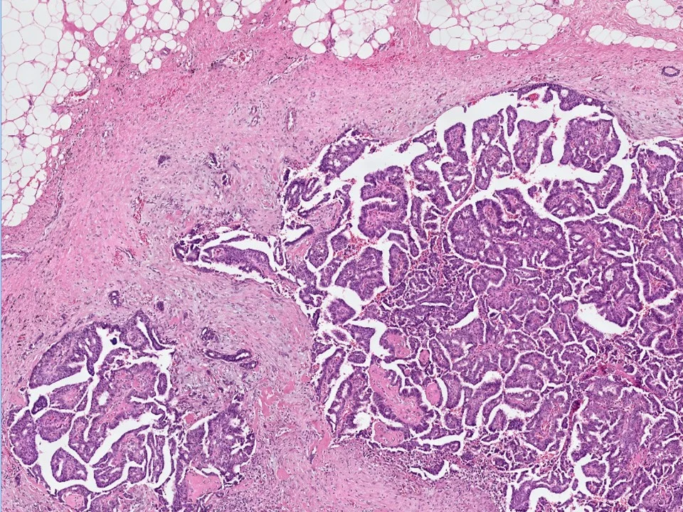 Encapsulated Papillary Carcinoma