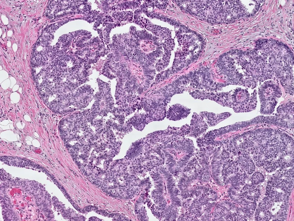 Ductal Carcinoma In Situ, Papillary Type