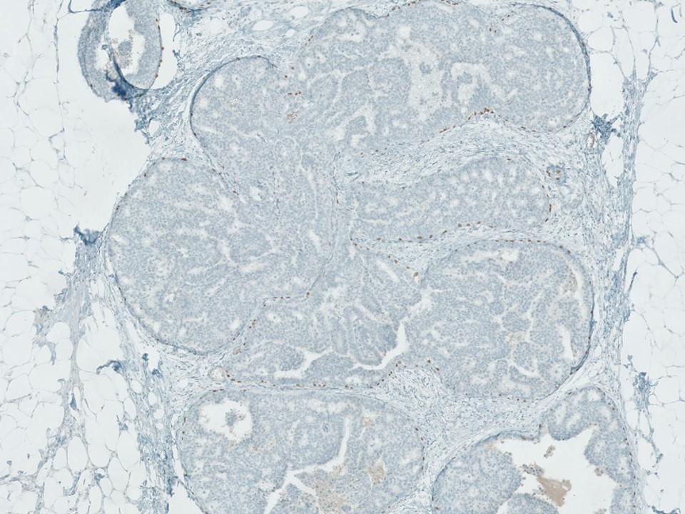 Ductal Carcinoma In Situ, Papillary Type, p63