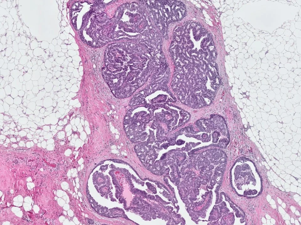 Ductal Carcinoma In Situ, Papillary Type