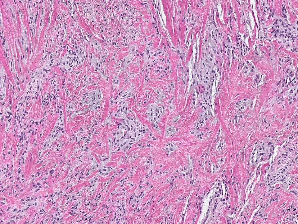Myofibroblastoma