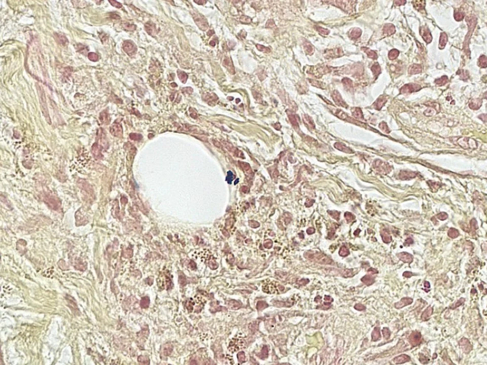 Cystic Neutrophilic Granulomatous Mastitis