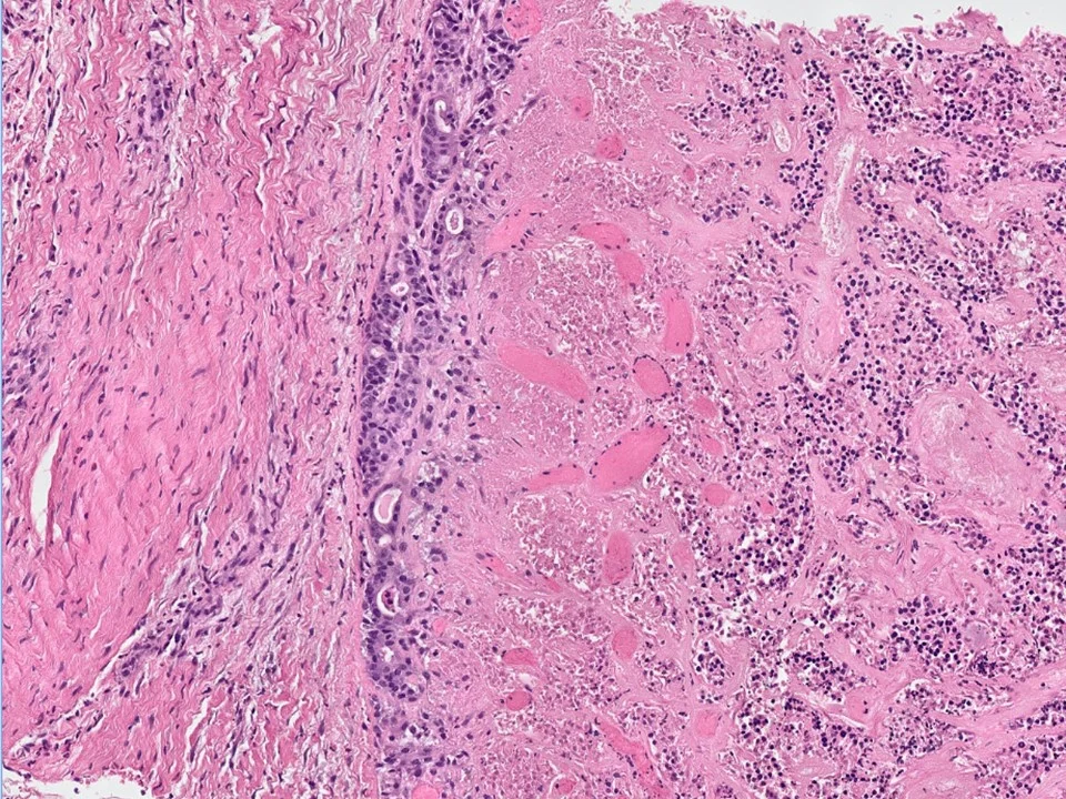 Biopsy Site Changes, Infarction of Papillary Lesion