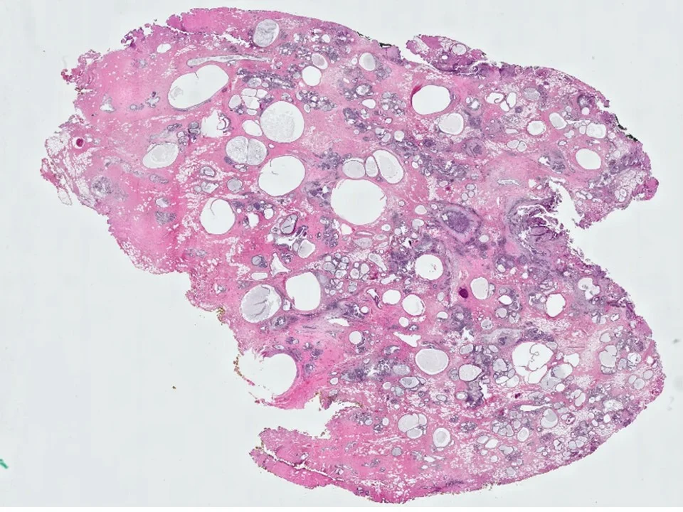 Juvenile Papillomatosis