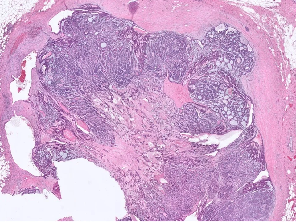 Adenomyoepithelioma