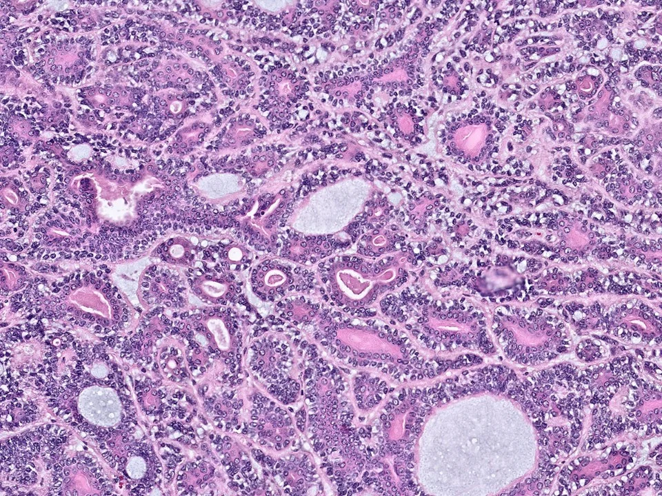 Adenomyoepithelioma