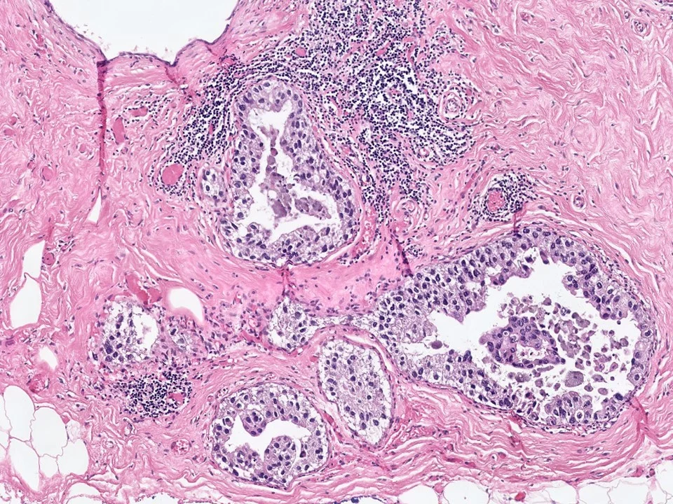 Microinvasive Carcinoma