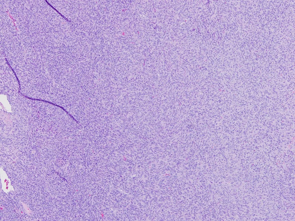 Malignant Phyllodes Tumor