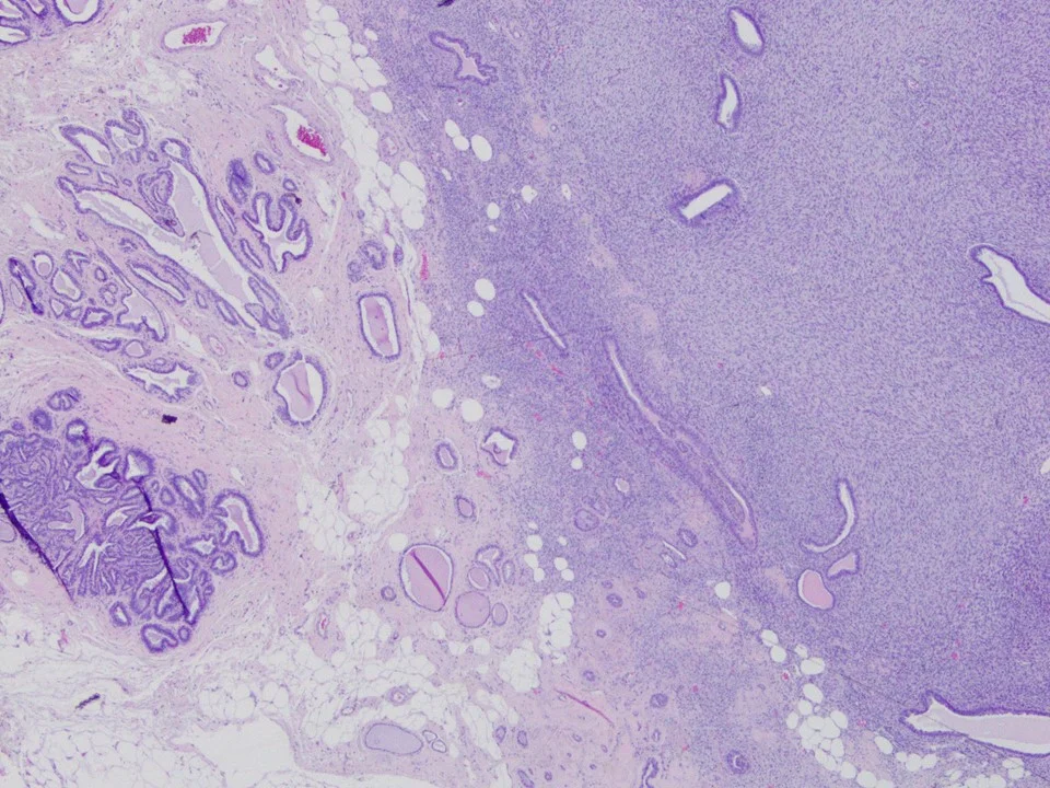 Malignant Phyllodes Tumor