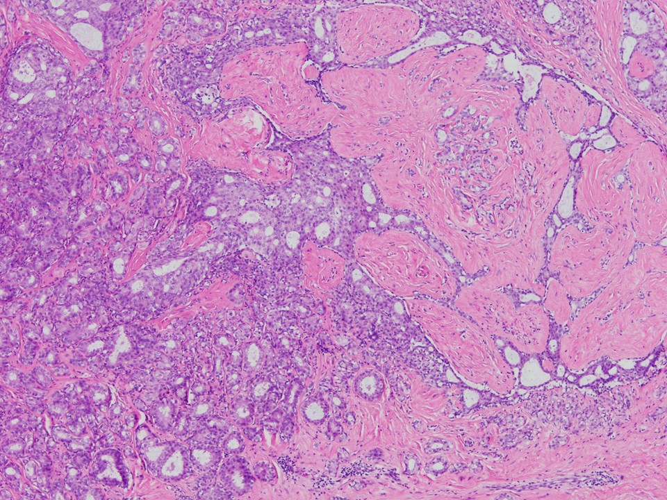 Fibroadenoma With Involvement by DCIS