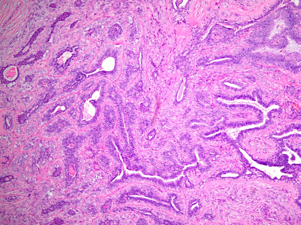 Metaplastic Carcinoma, Adenosquamous Carcinoma
