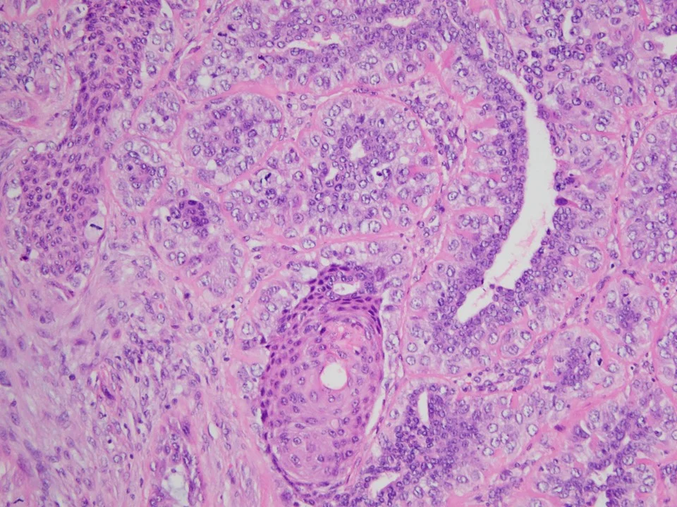 Metaplastic Carcinoma, Adenosquamous Carcinoma