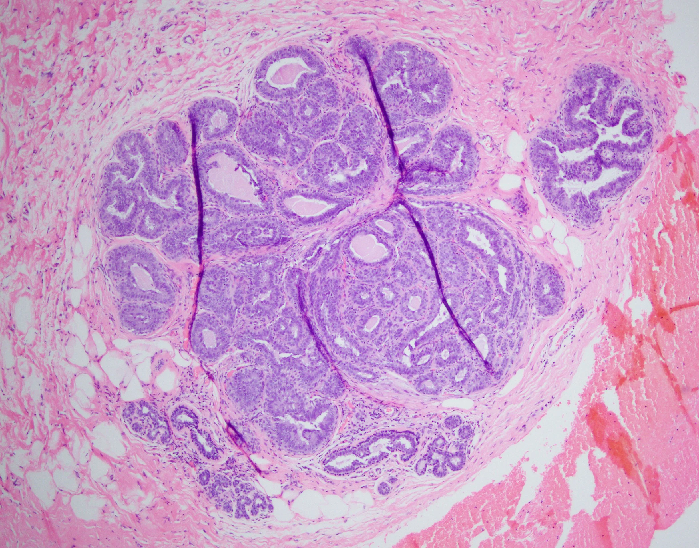 Columnar Cell Hyperplasia