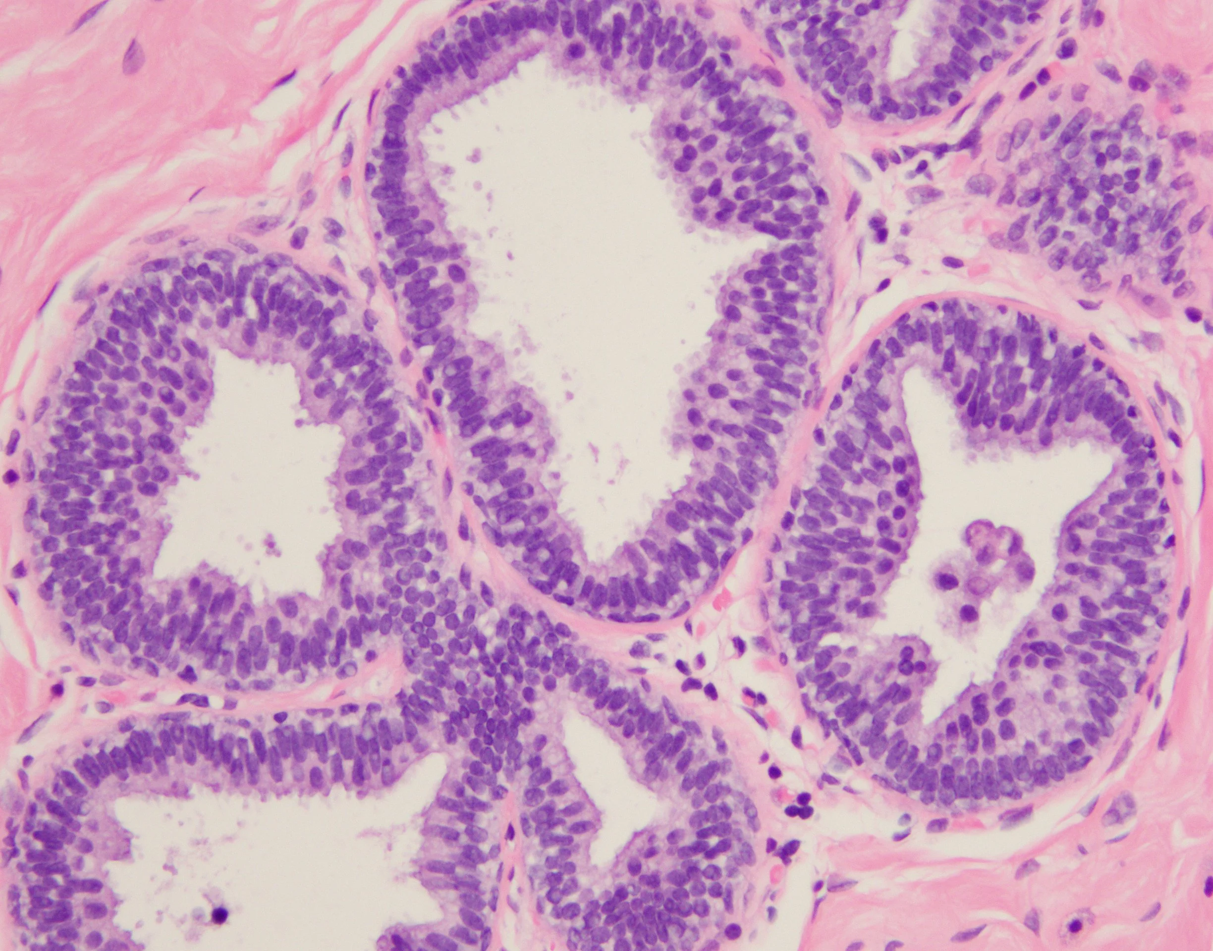 Columnar Cell Hyperplasia