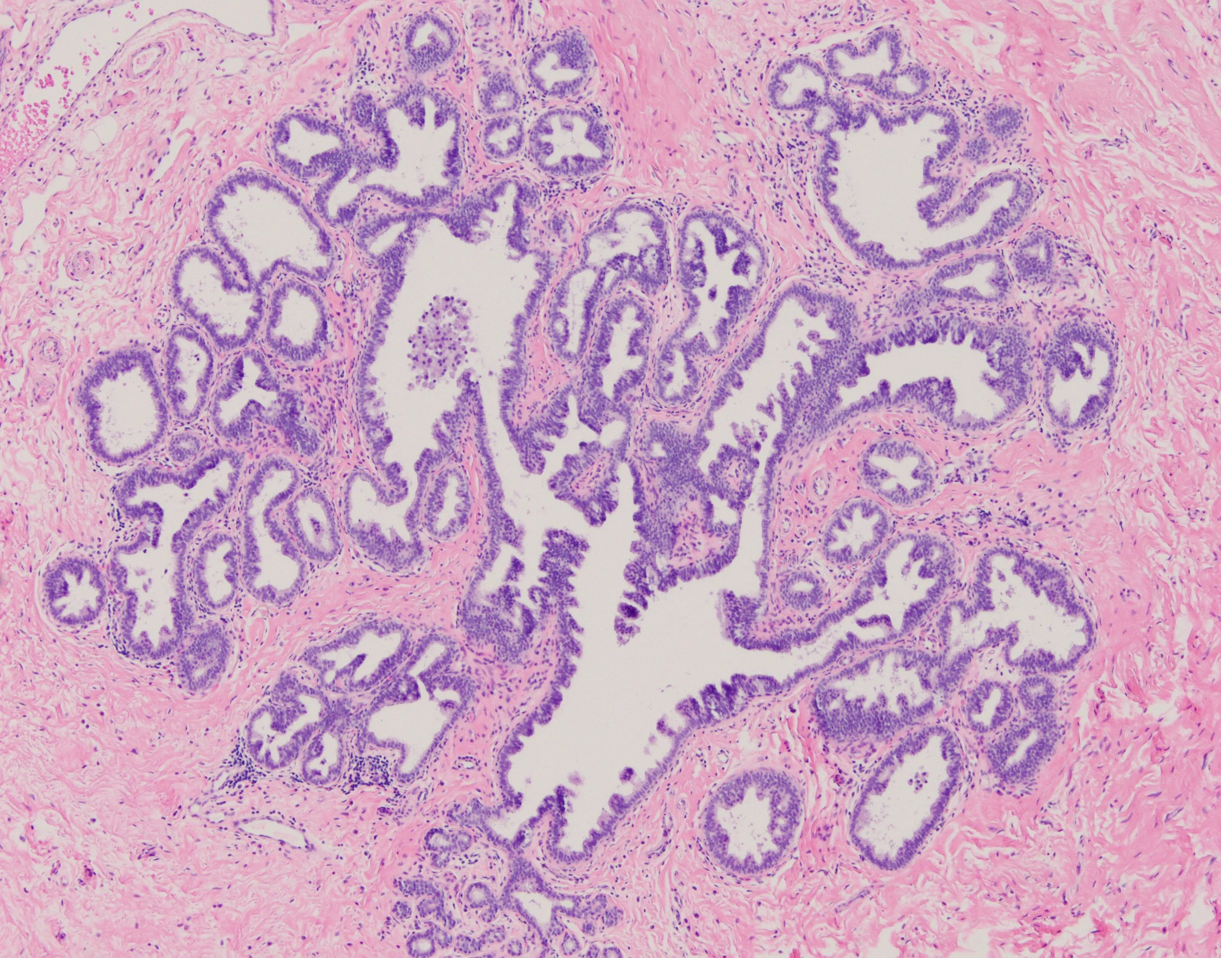 Columnar Cell Hyperplasia