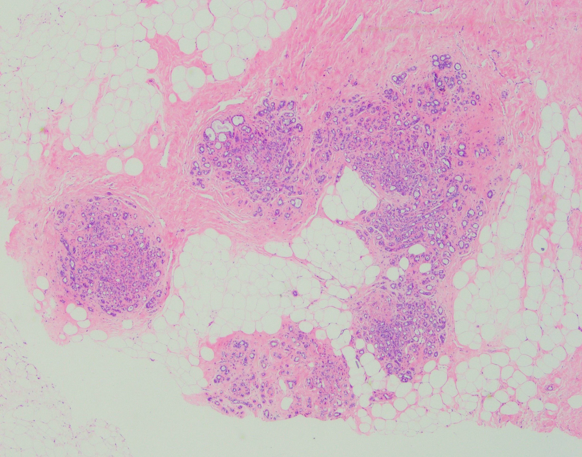 Sclerosing Adenosis