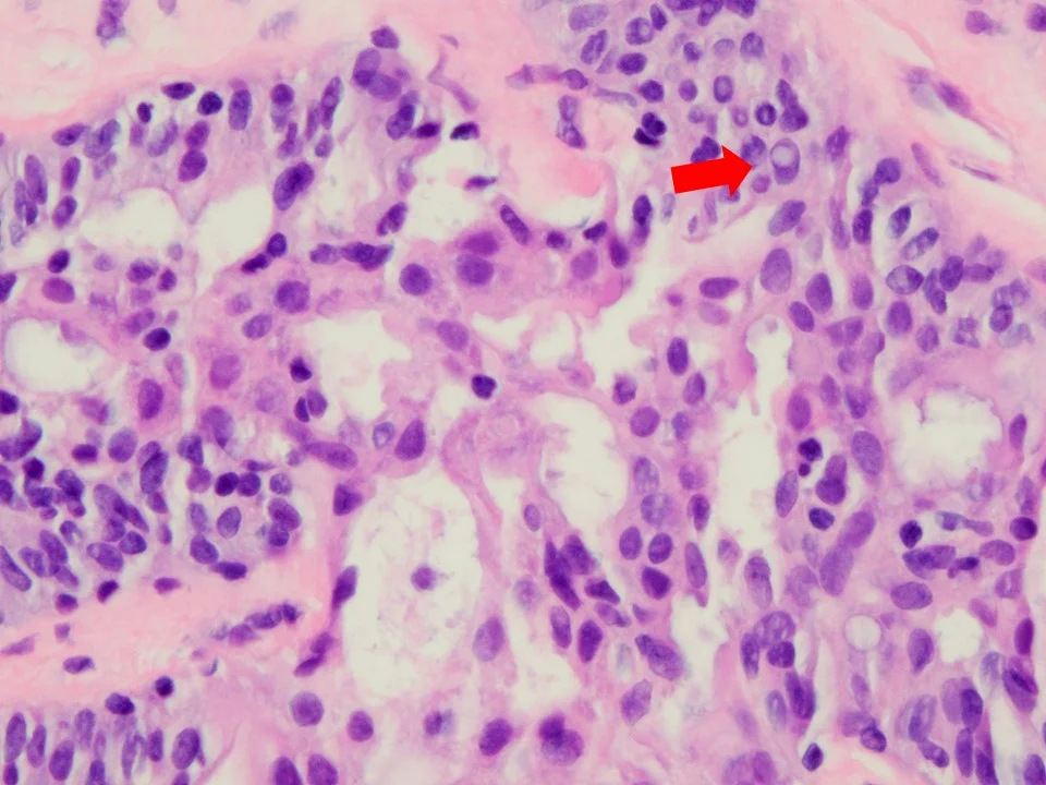 Usual Ductal Hyperplasia, with Apocrine Metaplasia