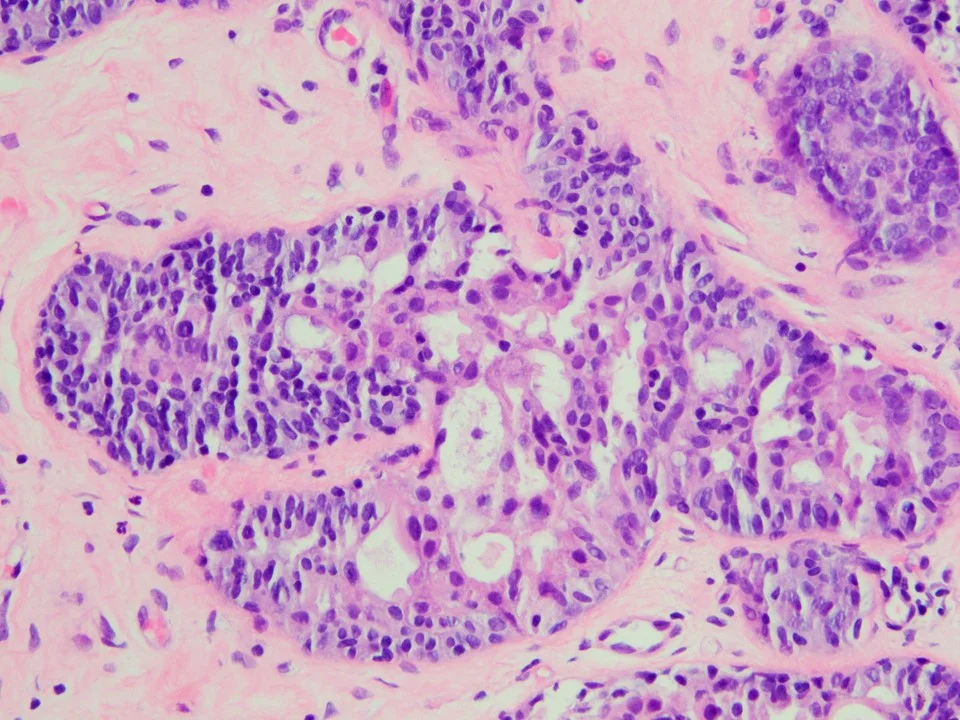 Usual Ductal Hyperplasia, with Apocrine Metaplasia