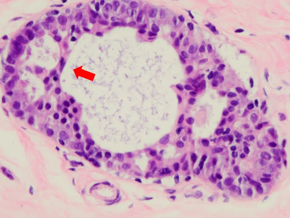 Usual Ductal Hyperplasia