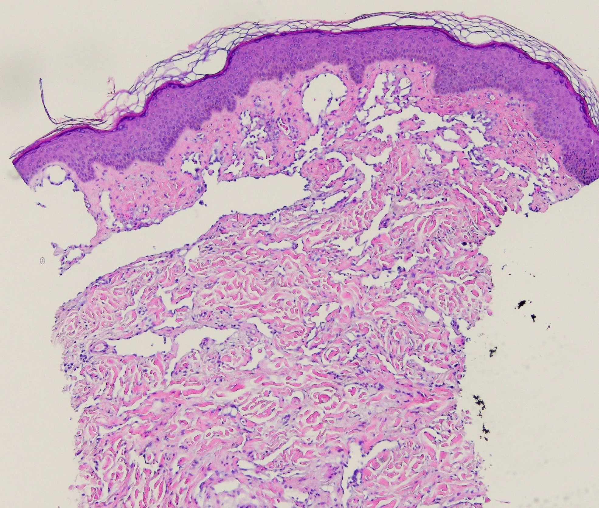 Angiosarcoma