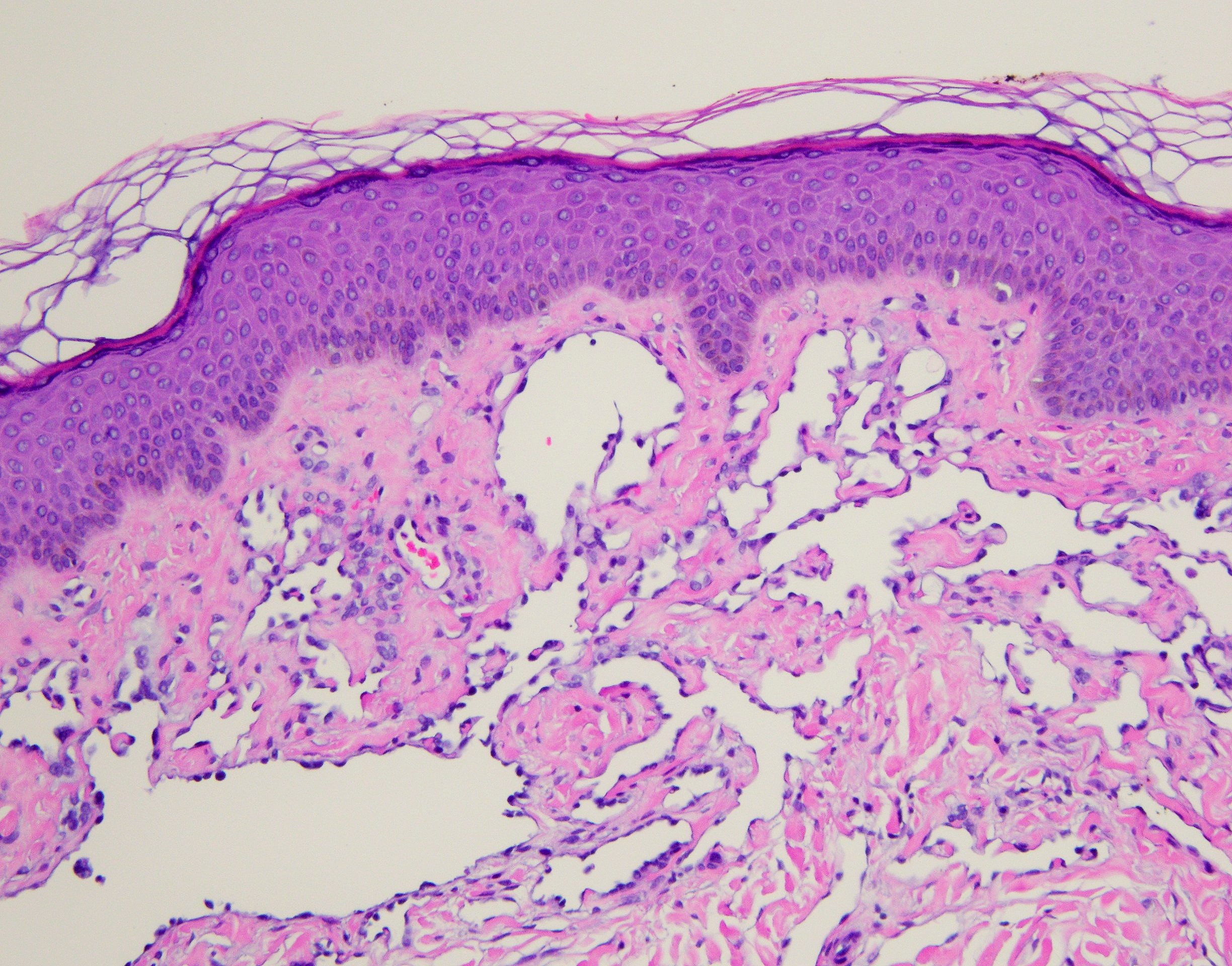 Angiosarcoma
