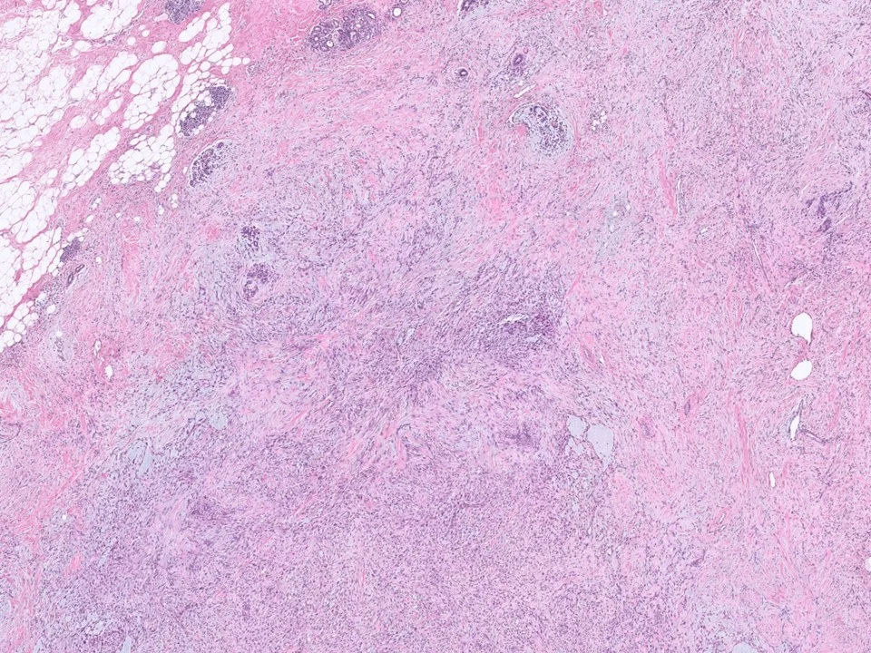 Metaplastic Carcinoma, Spindle Cell Type