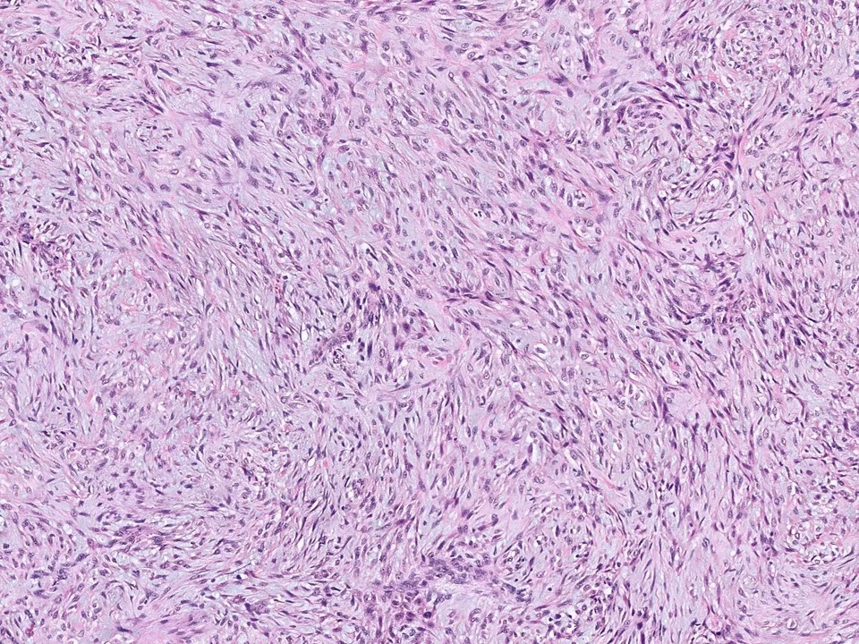 Metaplastic Carcinoma, Spindle Cell Type