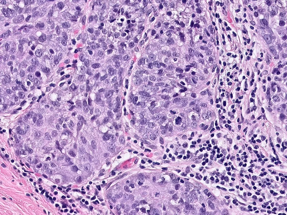 Ductal Carcinoma In Situ Involving Lobules