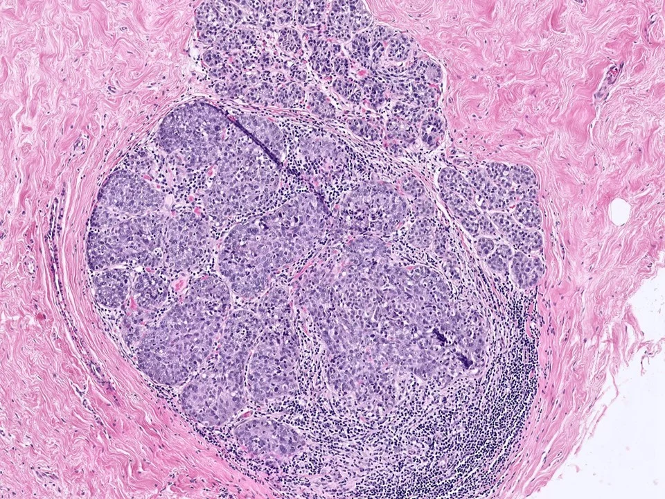 Ductal Carcinoma In Situ Involving Lobules
