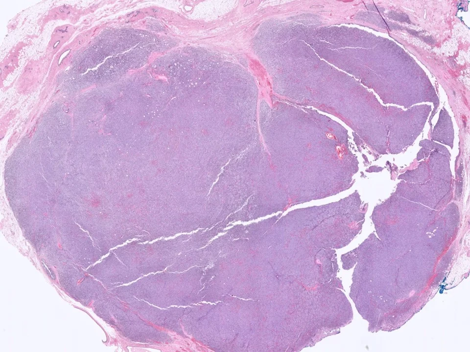 Invasive Lobular Carcinoma, Alveolar Variant