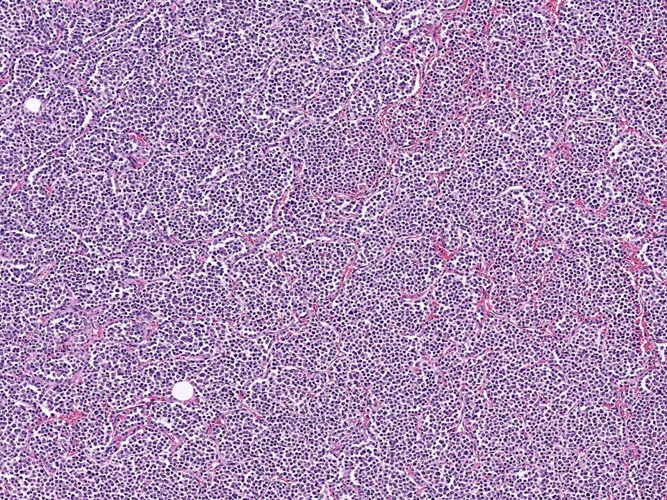 Invasive Lobular Carcinoma, Alveolar Variant