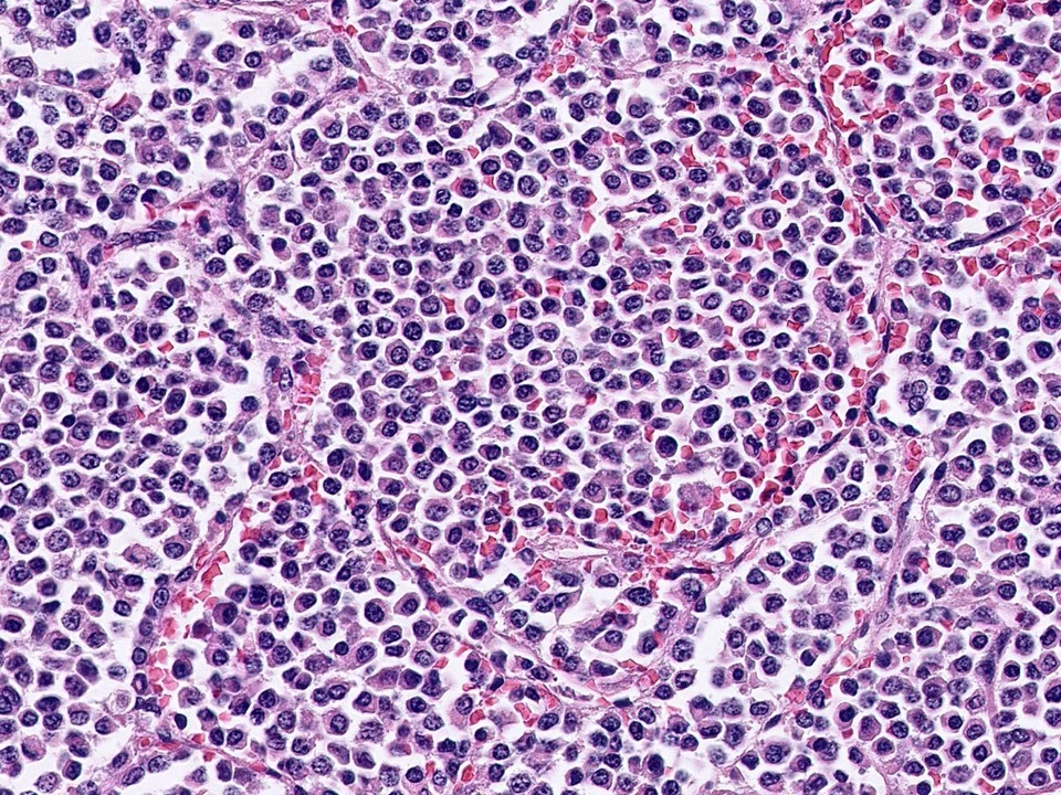 Invasive Lobular Carcinoma, Alveolar Variant