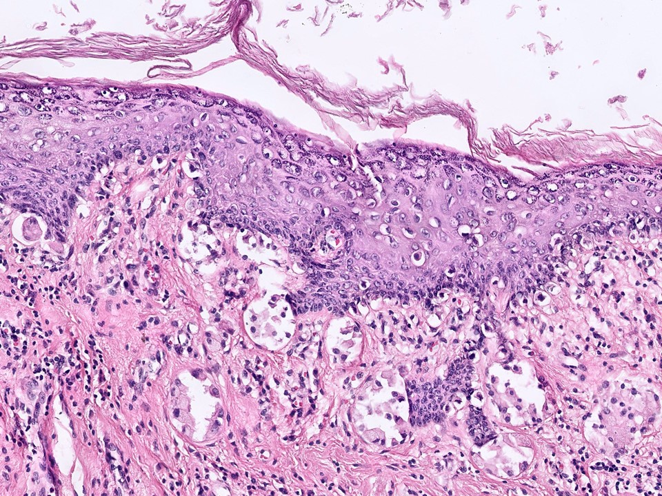 Paget's Disease of the Nipple