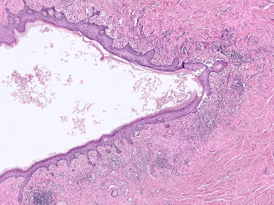 Paget's Disease of the Nipple