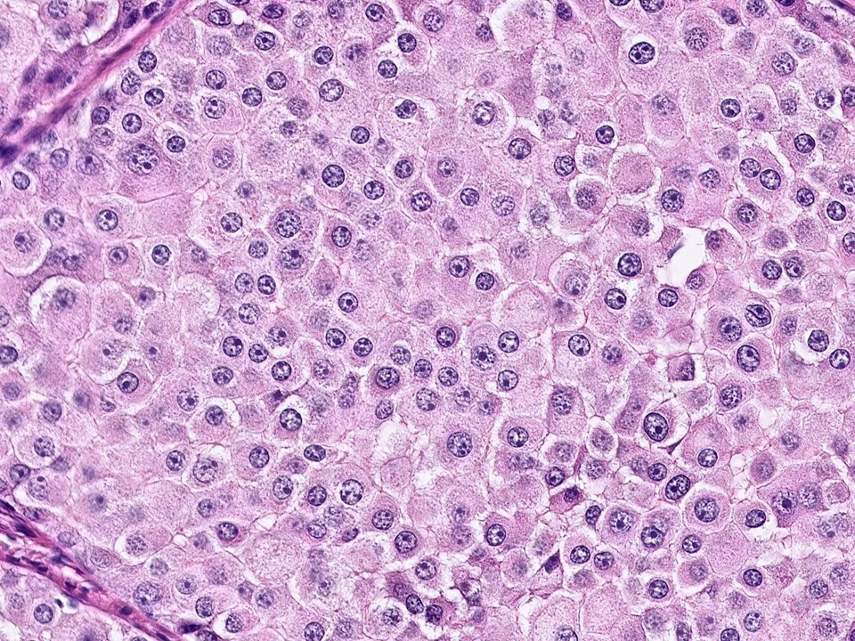 Ductal Carcinoma In-Situ, With Apocrine Features