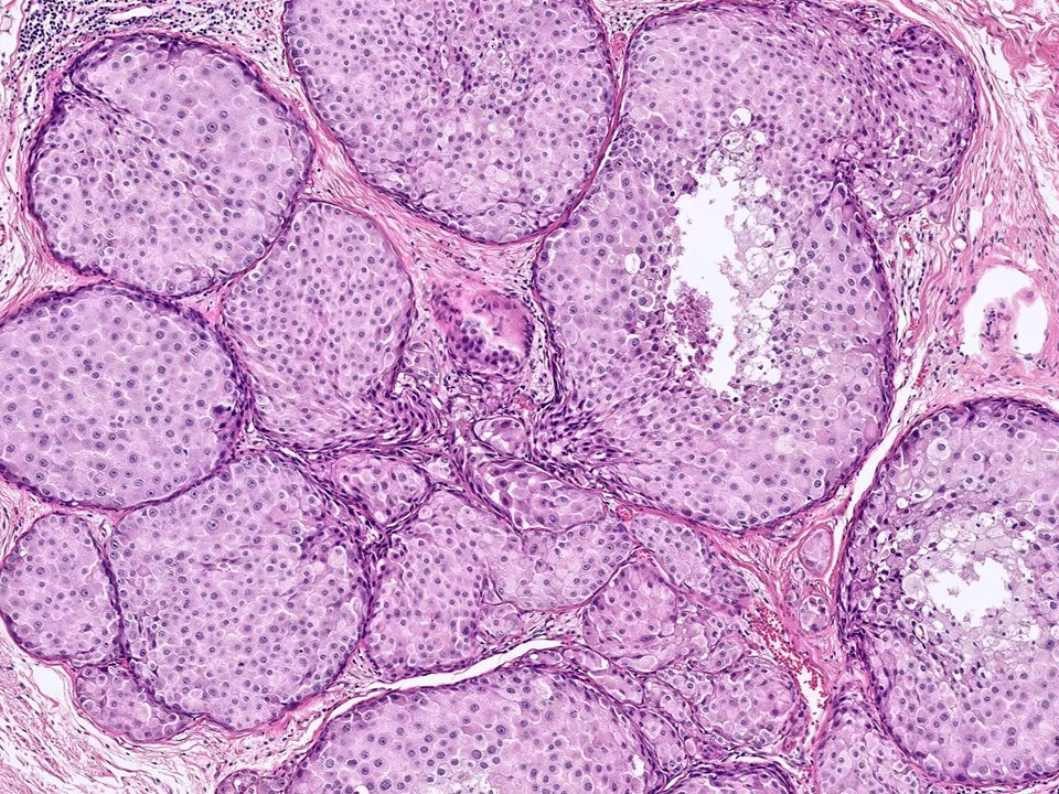 Ductal Carcinoma In-Situ, With Apocrine Features