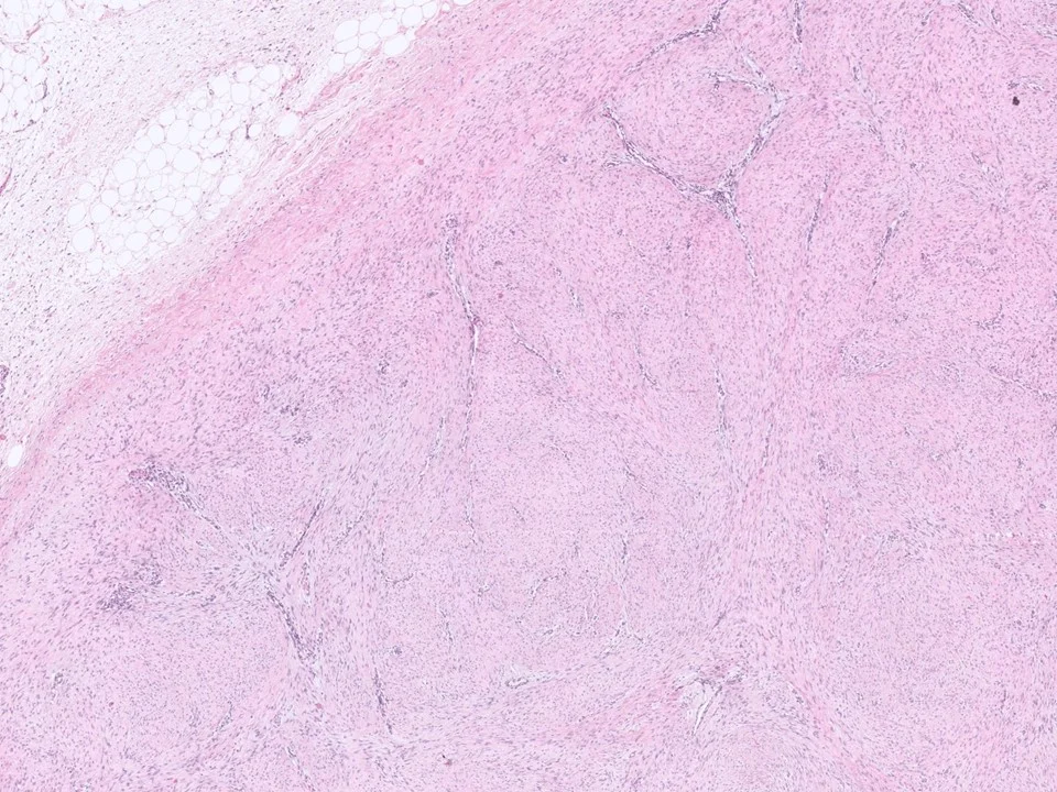 Fibromatosis