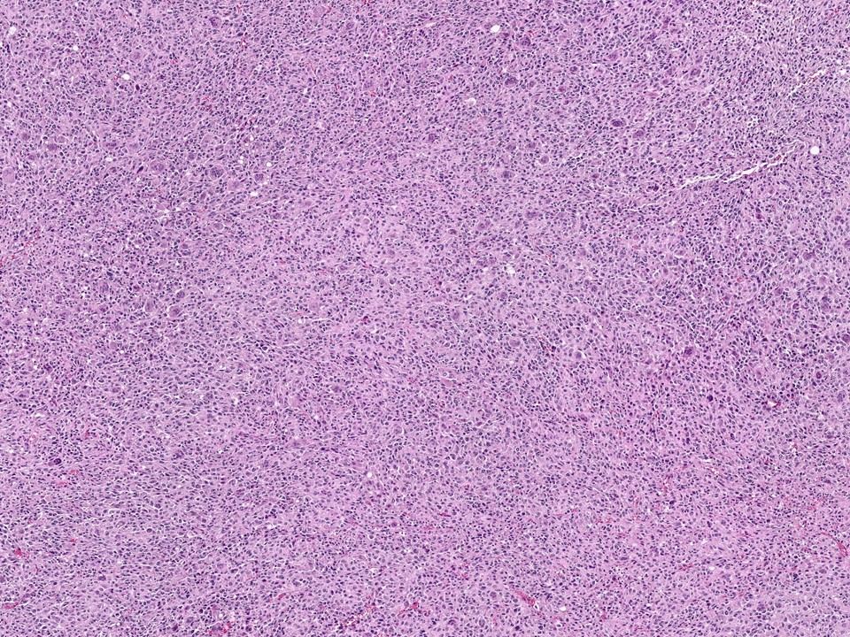 Metaplastic Carcinoma, With Osteoclast-Type Giant Cells