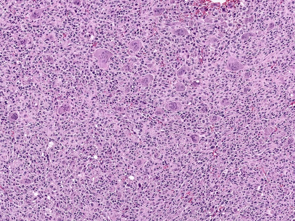 Metaplastic Carcinoma, With Osteoclast-Type Giant Cells
