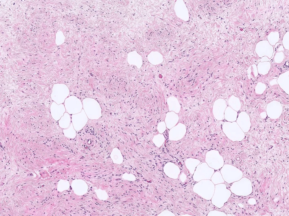 Myofibroblastoma