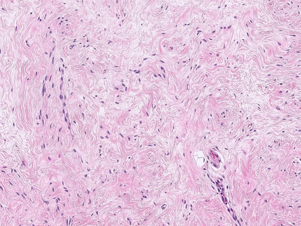 Myofibroblastoma