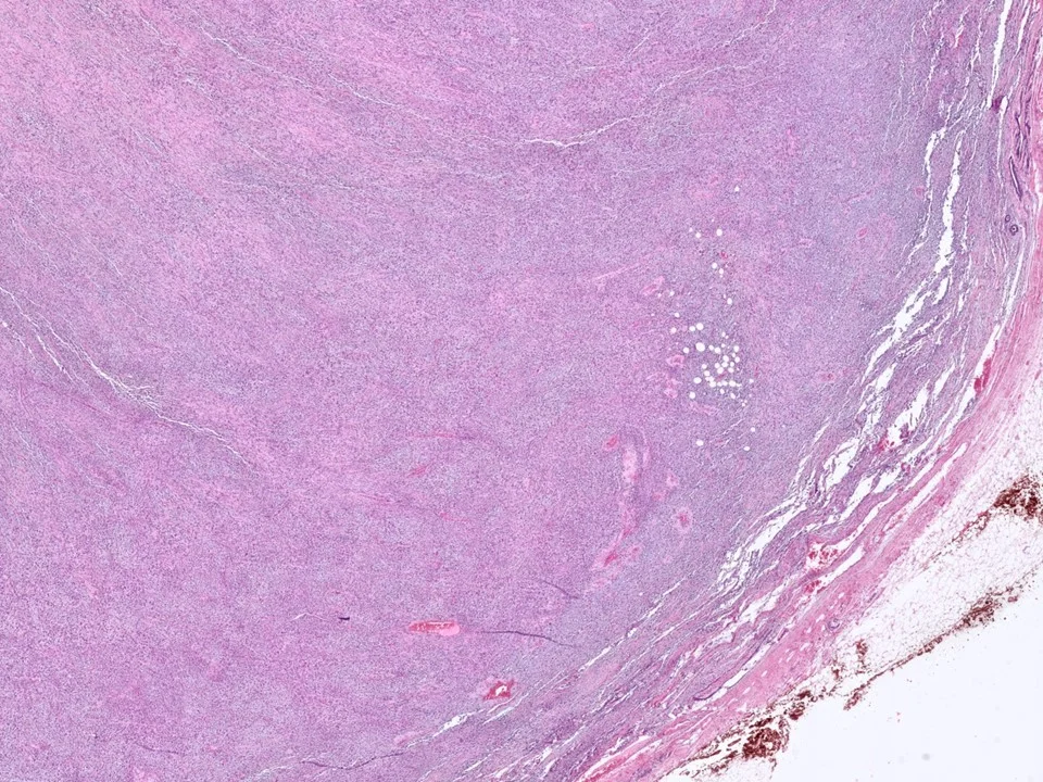 Metaplastic Carcinoma