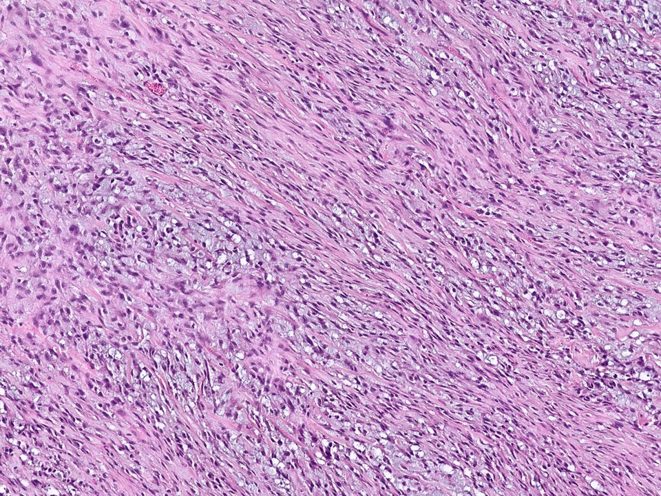 Metaplastic Carcinoma