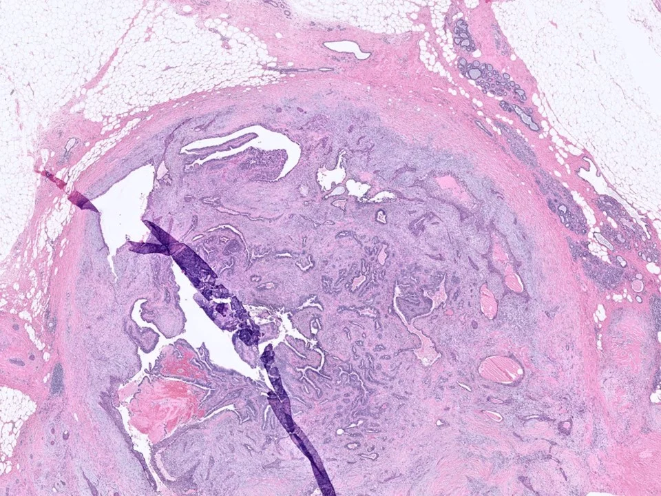 Low-Grade Adenosquamous Carcinoma Arising in Association with a Sclerosing Papilloma