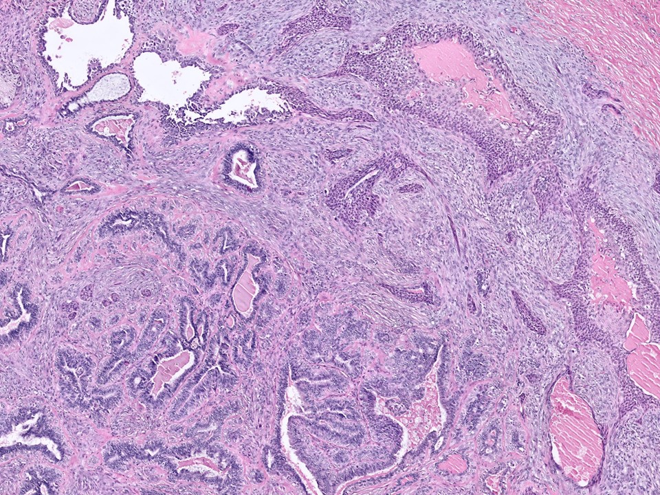 Low-Grade Adenosquamous Carcinoma Arising in Association with a Sclerosing Papilloma