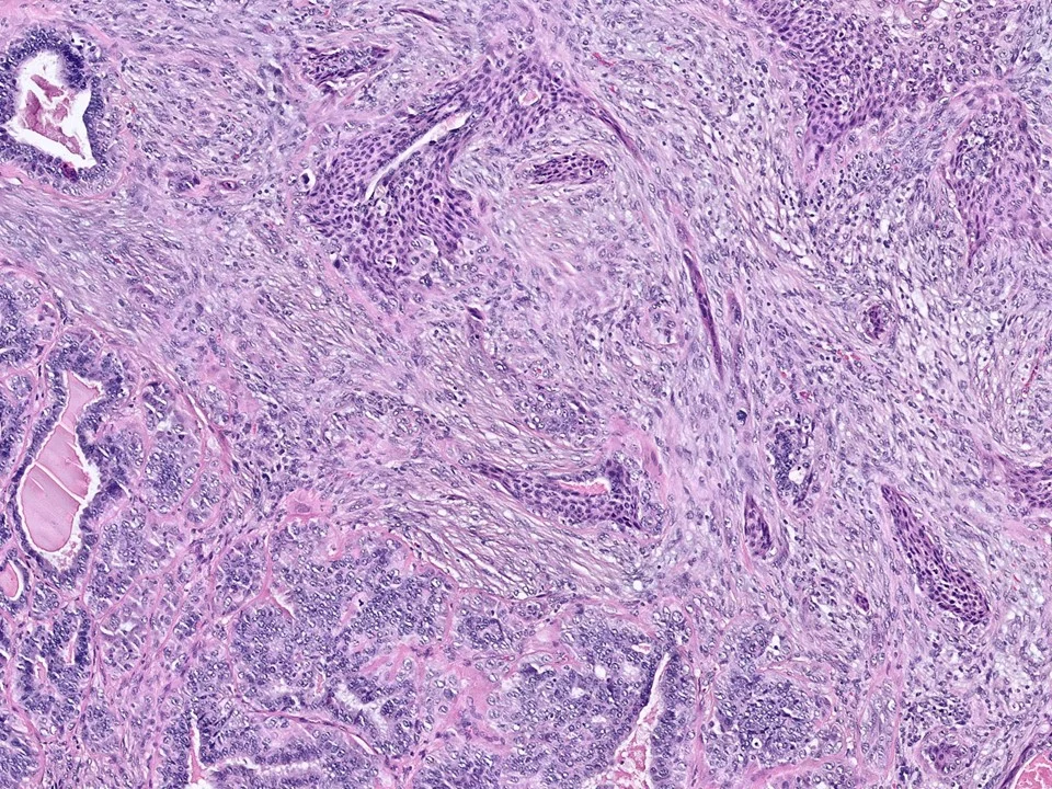 Low-Grade Adenosquamous Carcinoma Arising in Association with a Sclerosing Papilloma