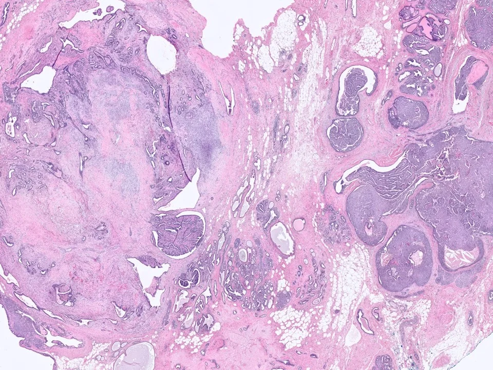Metaplastic Carcinoma, Spindle Cell Type, Arising in Association with Sclerosing Papillomas