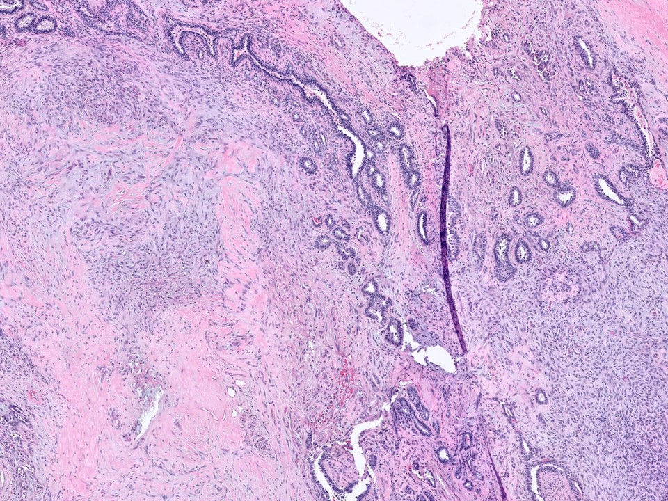 Metaplastic Carcinoma, Spindle Cell Type, Arising in Association with Sclerosing Papillomas