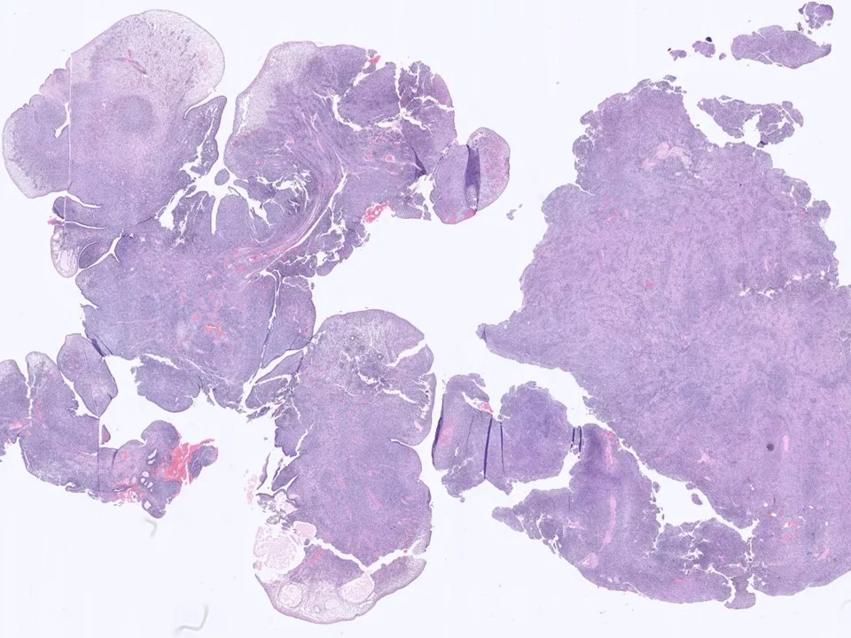 Malignant Phyllodes Tumor