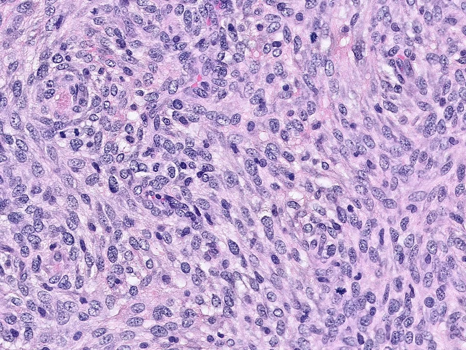 Malignant Phyllodes Tumor